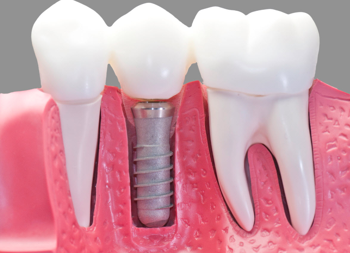 dentalimplants