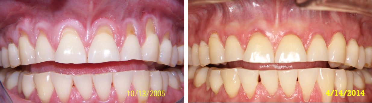 The Link Between Oral Bacteria & Memory