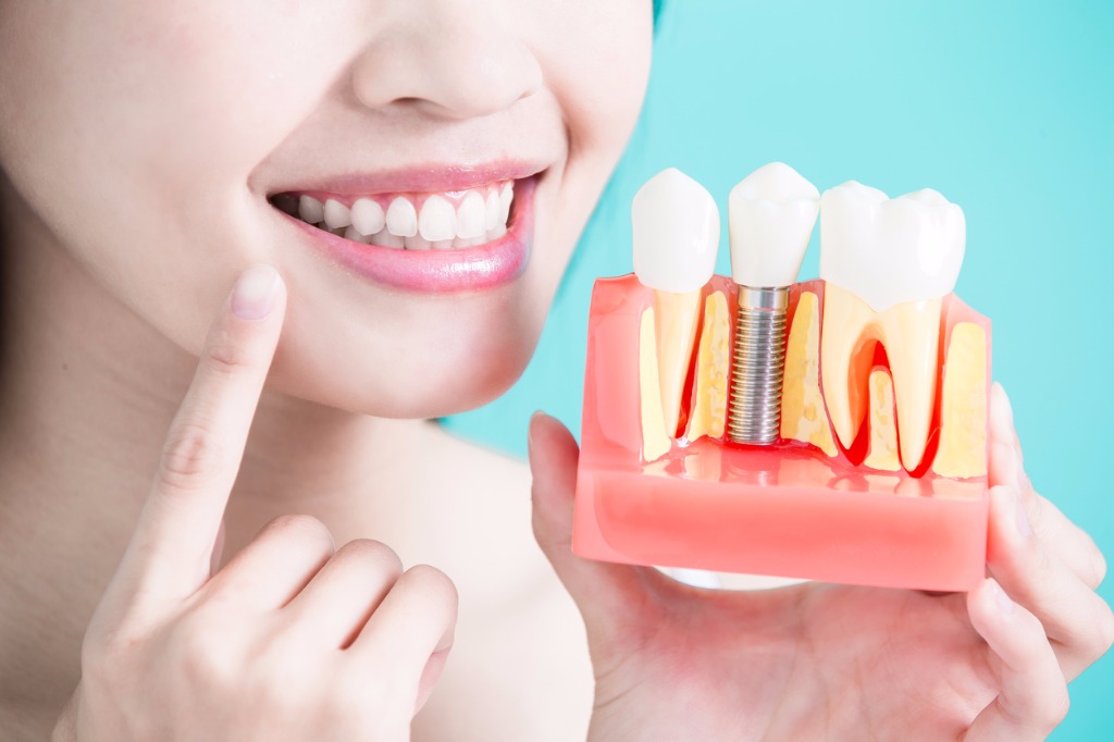 Dental Implants Sydney