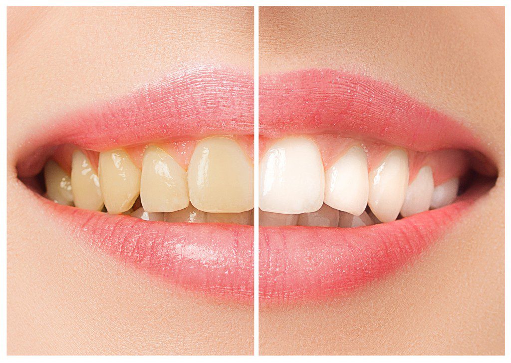 The female teeth before and after whitening. Collage